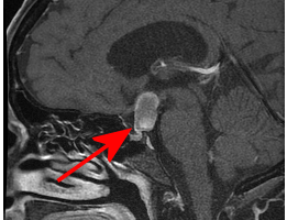 sagittal section showing craniopharyngioma