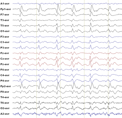 Characteristic 1 Hz spike and wave EEG of CJD