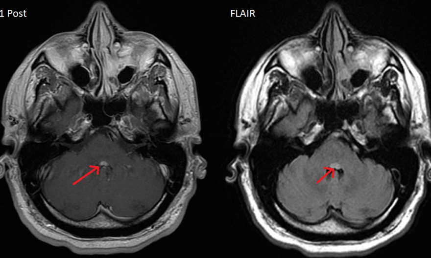 Facial colliculus MRI