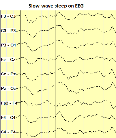 Slow-wave sleep on EEG