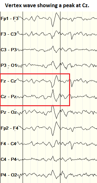 Vertex wave on bipolar montage EEG