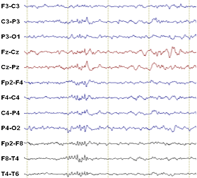 Benign EEG pattern 14-and-6 Hz positive bursts
