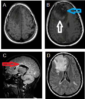 Tumefactive MS on MRI