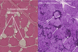 McArdle disease, H&E and PAS stain