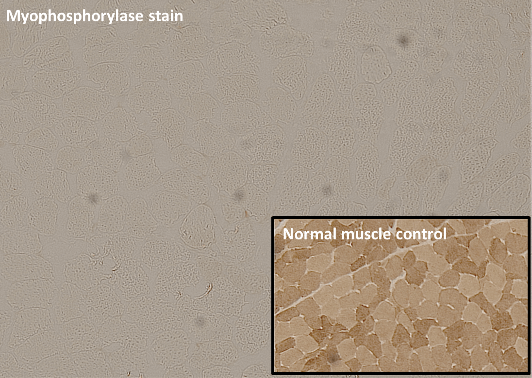 McArdle Disease myophosphorylase stain
