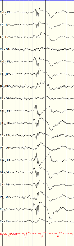Juvenile Myoclonic Epilepsy: polyspike and wave EEG