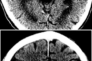 Dense MCA sign in R hemisphere