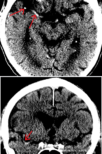 Dense MCA sign in R hemisphere