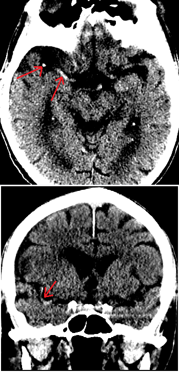 Dense MCA sign in R hemisphere