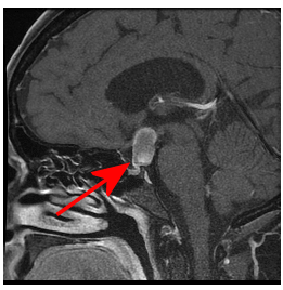 sagittal section showing craniopharyngioma