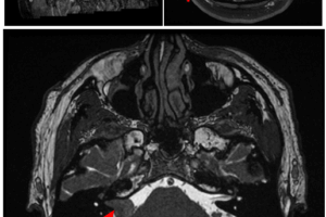 Tumor in the CPA