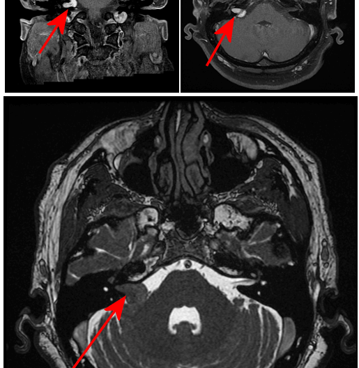 Tumor in the CPA