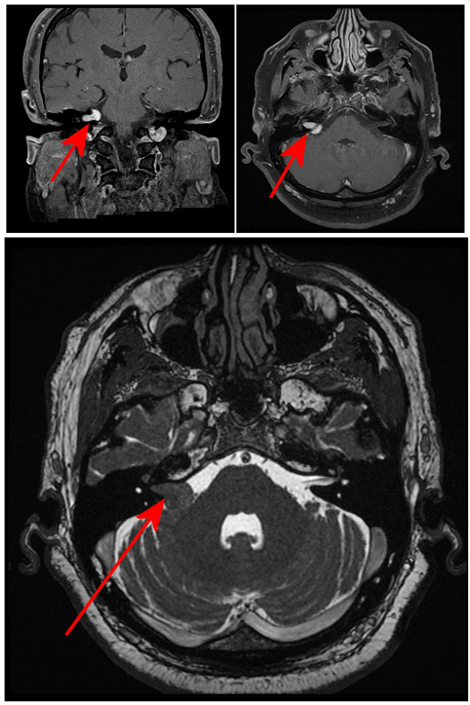 Tumor in the CPA