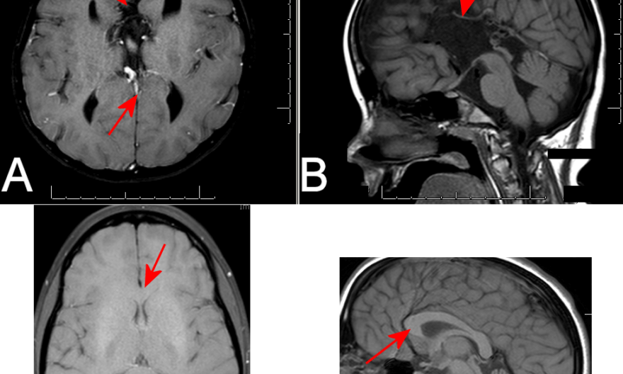 corpus callosum mri