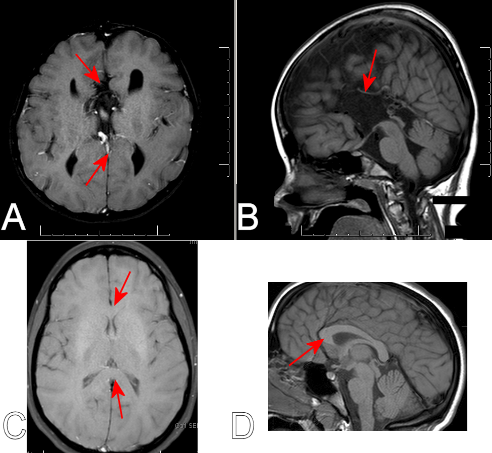 corpus callosum mri