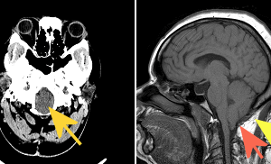 Chiari malformation Type 1