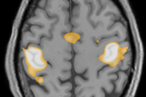 fMRI showing activity in the hand region of the primary motor cortex.