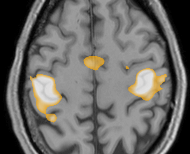 fMRI showing activity in the hand region of the primary motor cortex.