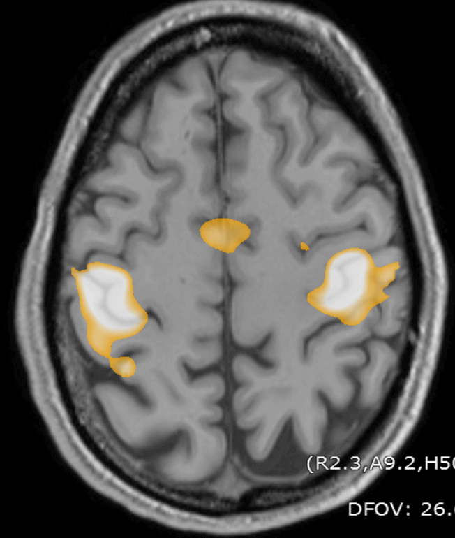 fMRI showing activity in the hand region of the primary motor cortex.