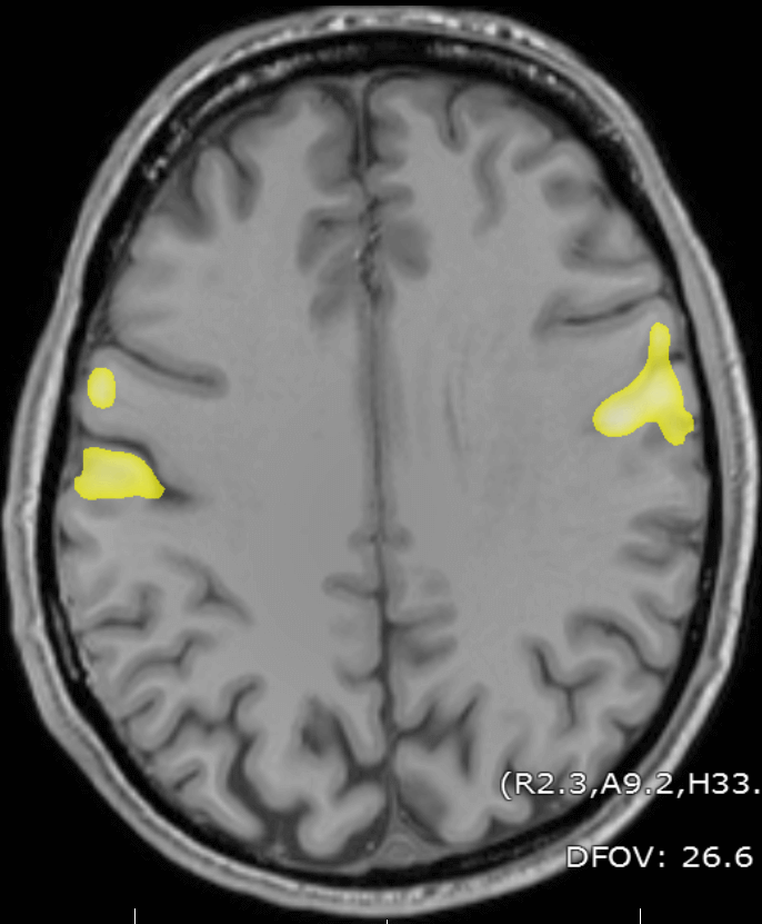 fMRI signal generated by tongue movement