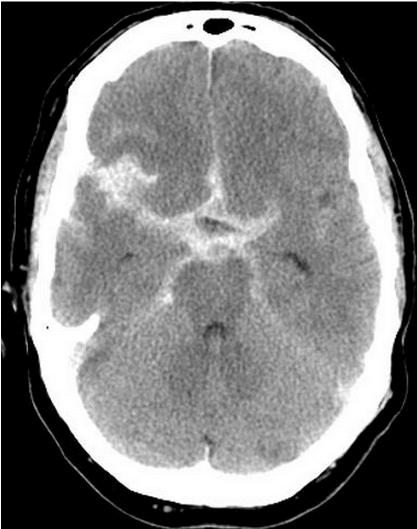 Subarachnoid hemorrhage on non-contrast CT