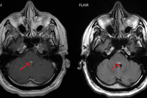 Facial colliculus MRI