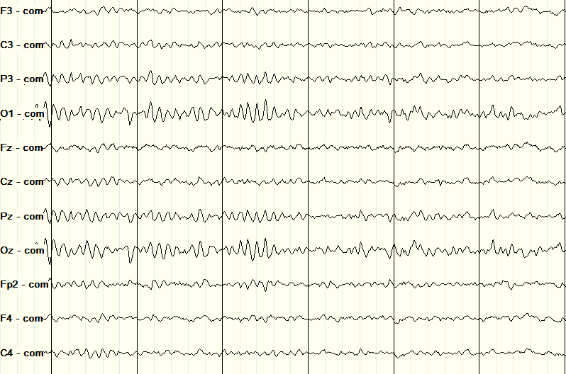 Stage 1 sleep EEG