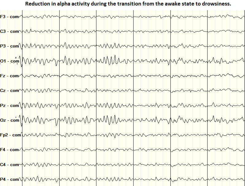 Stage 1 sleep EEG