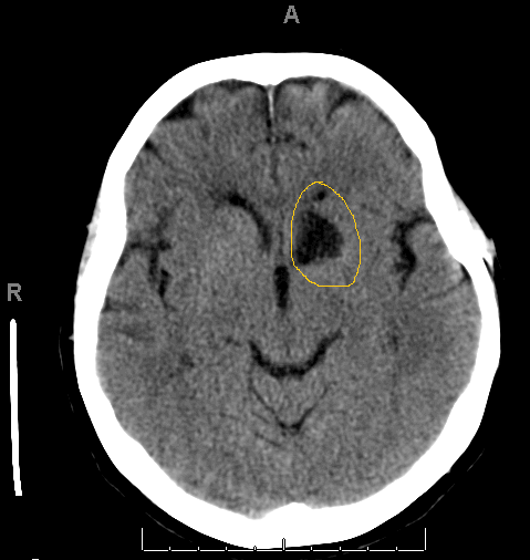 Infarct of the left recurrent artery of Heubner