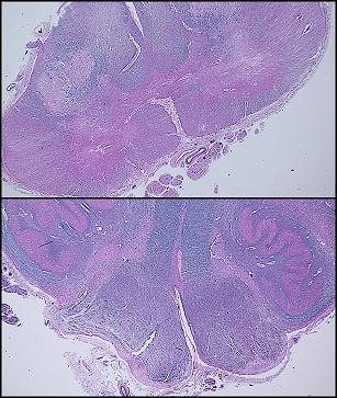 ALS spinal cord pathology