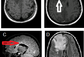 Tumefactive MS on MRI