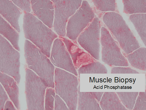 acid-phosphatase positive