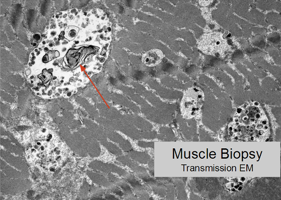 Lysosome dysfunction