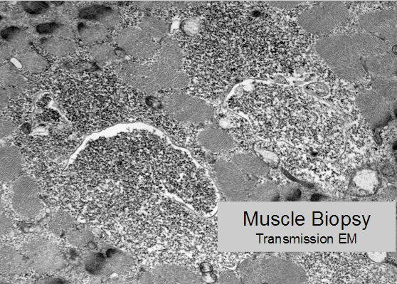 Glycogen in lysosome