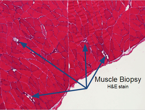 Vacuolar myopathy