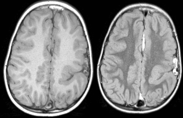 Schizencephaly