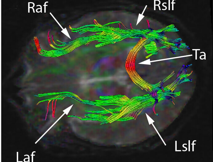 Cerebral white matter tracts by diffusion tensor imaging. Licensed under Creative Commons Attribution-Share Alike 3.0 via Wikimedia Commons