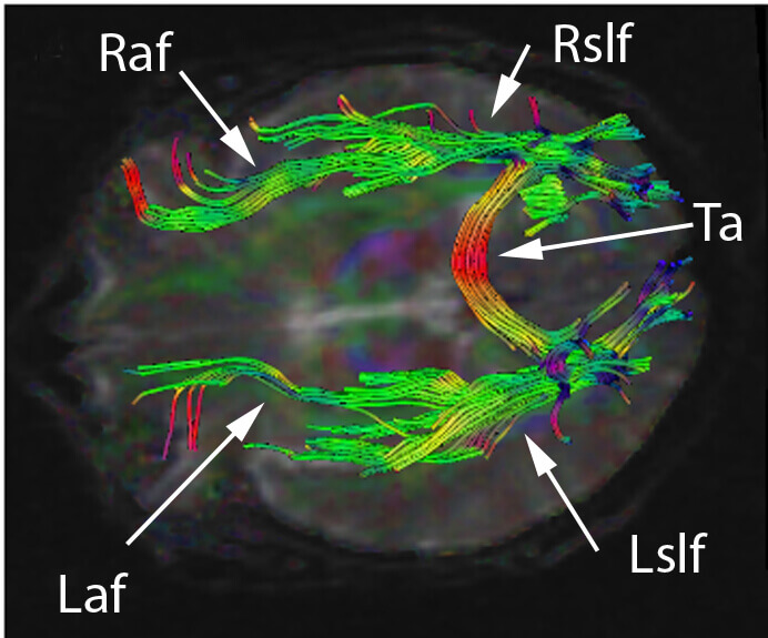 Cerebral white matter tracts by diffusion tensor imaging. Licensed under Creative Commons Attribution-Share Alike 3.0 via Wikimedia Commons