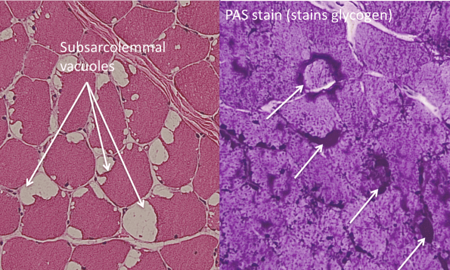 McArdle disease, H&E and PAS stain