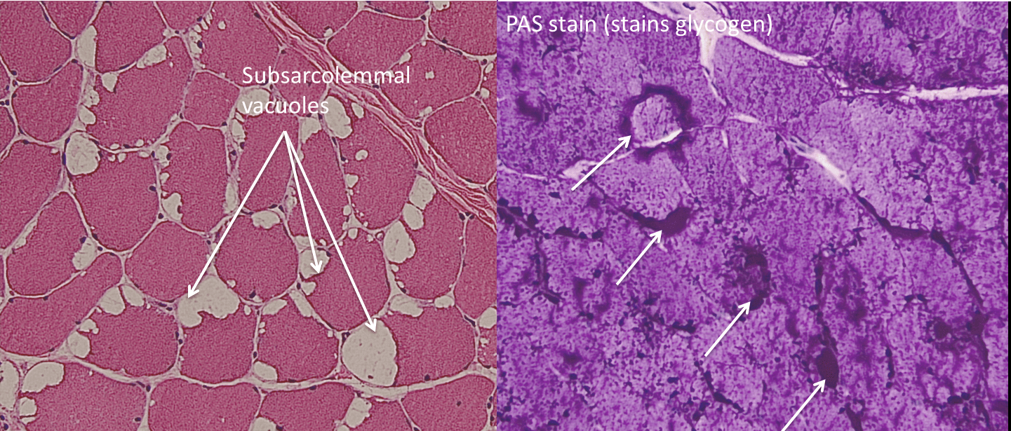 McArdle disease, H&E and PAS stain