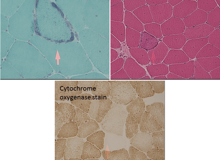 Mitochondrial myopathy seen on H&E stain, trichrome stain, CO stain