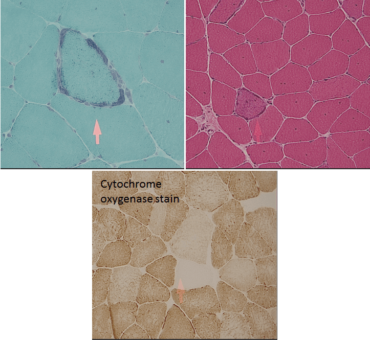 Mitochondrial myopathy seen on H&E stain, trichrome stain, CO stain