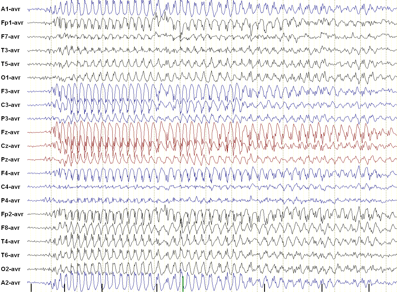 petit mal seizure in absence epilepsy: 3 Hz spike and wave EEG
